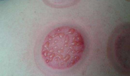 拔罐怎么拔视频教程,视频教程详解